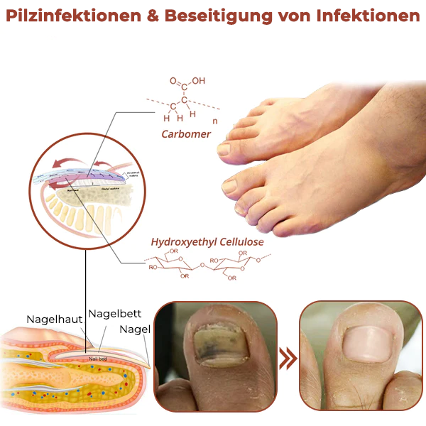 LLLT Nagelpilz - Revolutionäres hocheffizientes Lichttherapiegerät für Zehennagelkrankheiten
