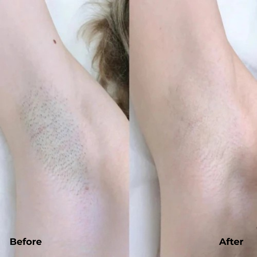 SeidenRasur™ Sanfte Haarentfernung