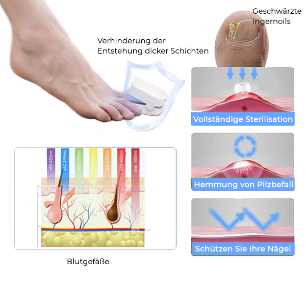 LLLT Nagelpilz - Revolutionäres hocheffizientes Lichttherapiegerät für Zehennagelkrankheiten
