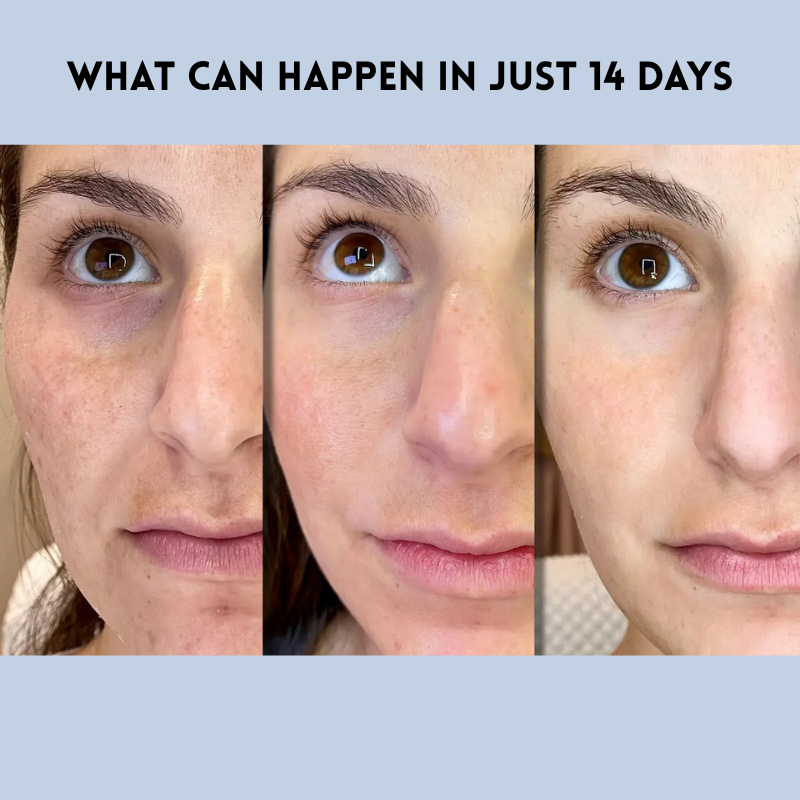 JugendLifting™ Sofortiges Jugendliches Lifting