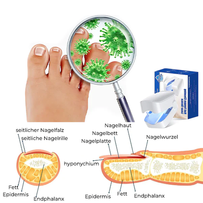 LLLT Nagelpilz - Revolutionäres hocheffizientes Lichttherapiegerät für Zehennagelkrankheiten