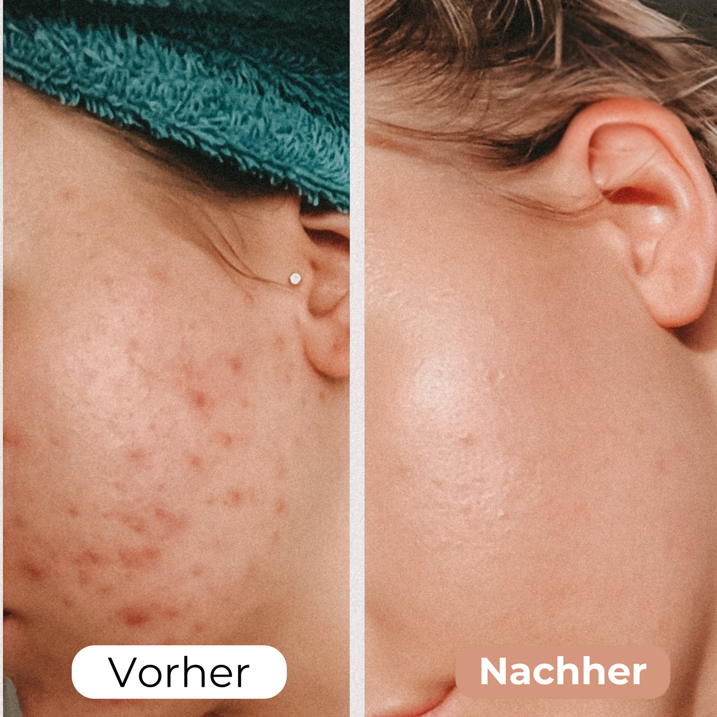 GoneWrinkle™ - Hydratisierte Faltenreduzierung